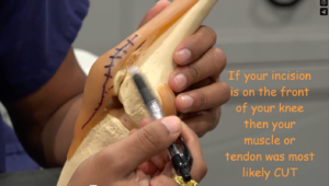 Knee surgery model showing potential incision site with a marker indicating a front knee incision suggesting muscle or tendon cut