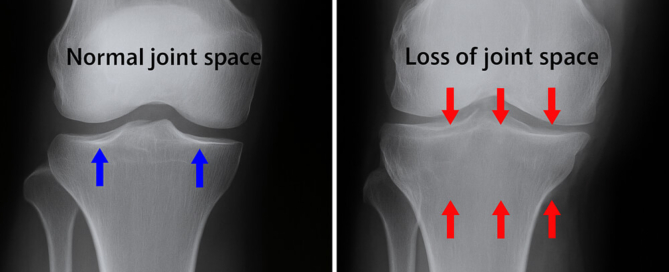 bone on bone knee arthritis x-ray image